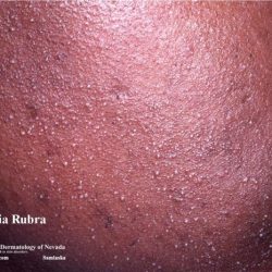 Rubra miliaria rash heat treatment