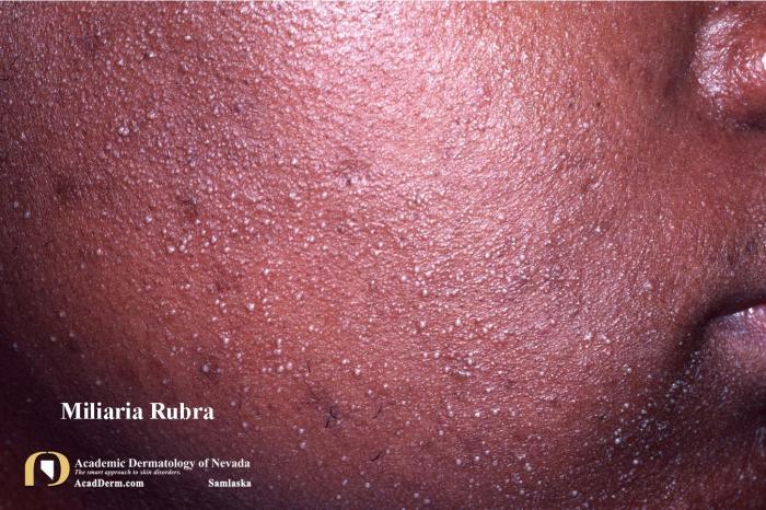 Rubra miliaria rash heat treatment